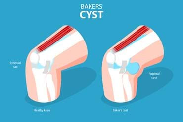Symptoms & Treatment of Facet Joint Pain