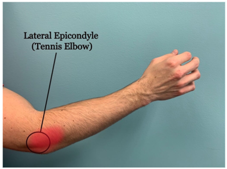 Pain over the outer elbow