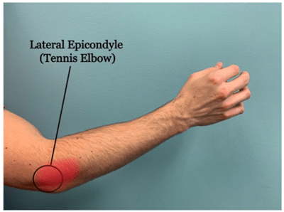 Tennis Elbow Treatment, Symptoms and Causes