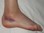 What should you do for an ankle sprain?