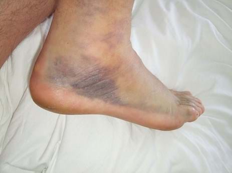 Rolled Ankle Sports Physiotherapy Myotherapy Melbourne