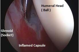 frozen shoulder physiotherapy melbourne