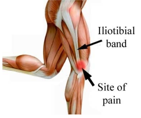 All you need to know about ITBS (Iliotibial band syndromme)