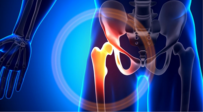 Treatment For Hip Bursitis and Causes Melbourne