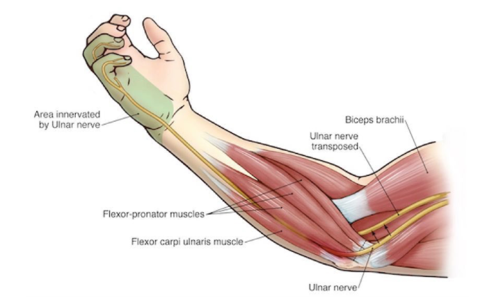 Ulnar Nerve Neuropathy - Symptoms, Risks &amp; Treatments